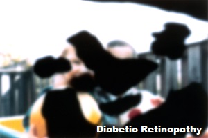 Diabetic Retinopathy Vision