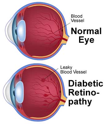 Diabetic eye