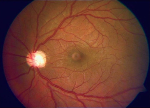 Glaucoma FUNDUS